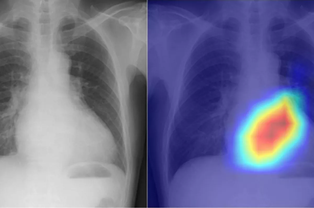 Yapay zeka, göğüs röntgeninden kalp hastalıklarını teşhis edecek